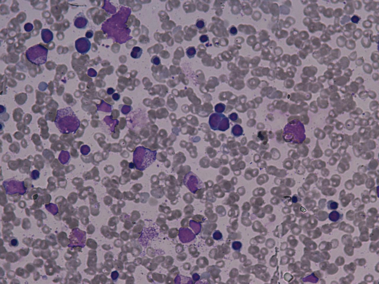 Paroxysmal Nocturnal Hemoglobinuria Blood Smear